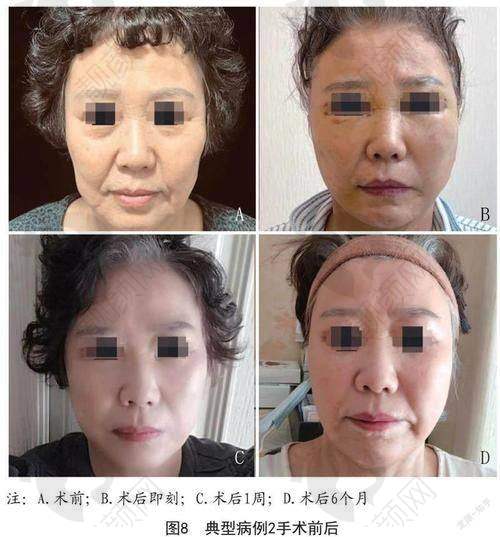精良技术，是手术成功的关键