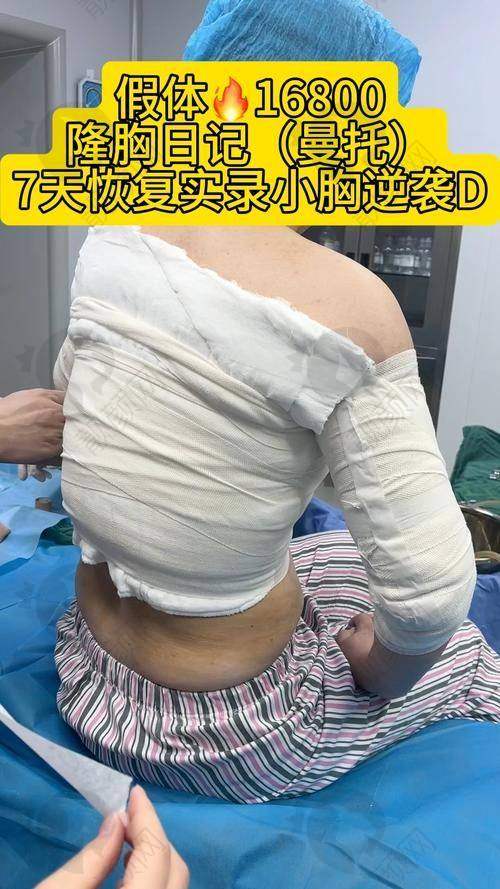 惊艳！曼托 275cc 假体隆胸的修复过程