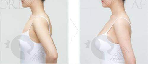 梁耀婵脂肪丰胸水平怎么样？