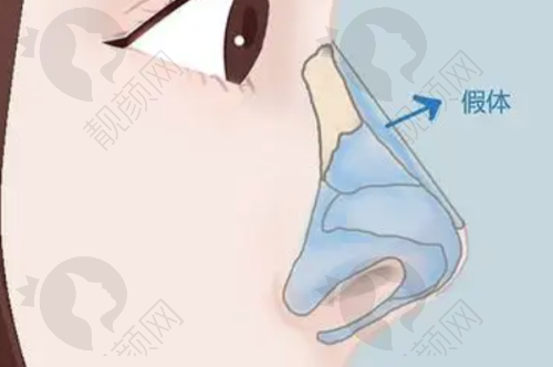 北京沃尔赵丹做鼻子实例