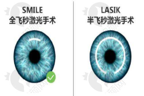 郑州视光眼科医院做近视手术怎么样?患者口碑良好