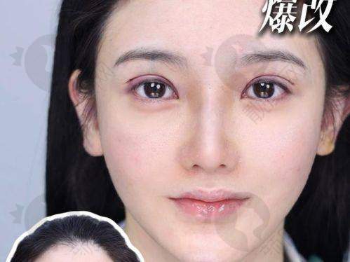 北京韩勋医生眼部修复技术真牛！价格透明，拒绝套路