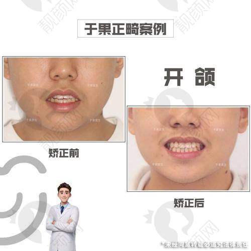 广州穗华口腔王林正畸项目价格表参考