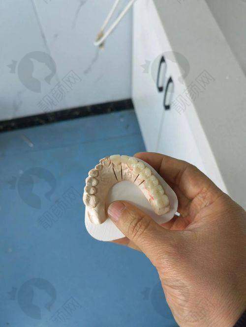 西捷美牙冠舒适度高吗？生物相容超友好