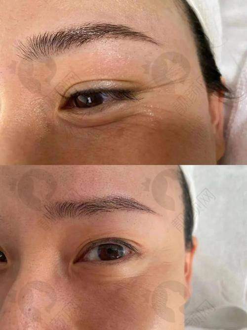 多型号可选，满足不同肌肤需求的韩国抗衰老针