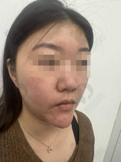 广州荔医馒化脸修复项目优势