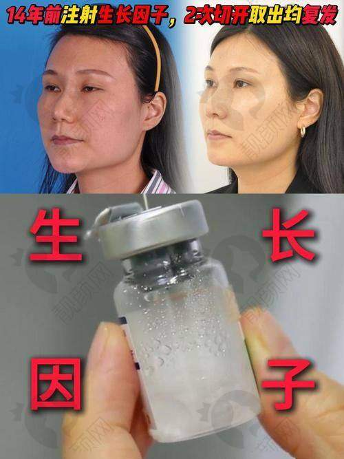 广州荔医馒化脸修复真实评价