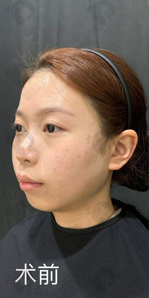 广州曙光除皱针项目具体优势