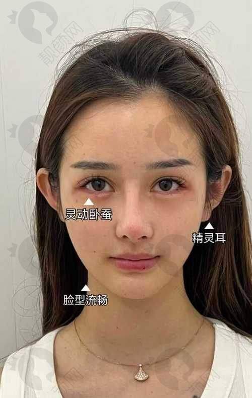 武汉五洲整形做脸部脂肪填充怎么样？特色技术显优势