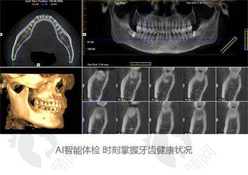 上海鼎植谢正新全口缺牙疑难种植实例