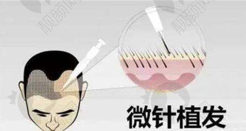 碧莲盛植发：正规靠谱有保护