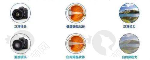 南通文慈白内障手术价格差异原因