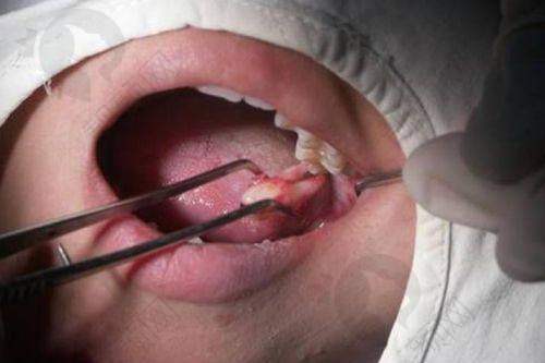 吴江金铂利口腔关鑫医生拔上颌正位智齿价格348元起,连锁品牌设备高端