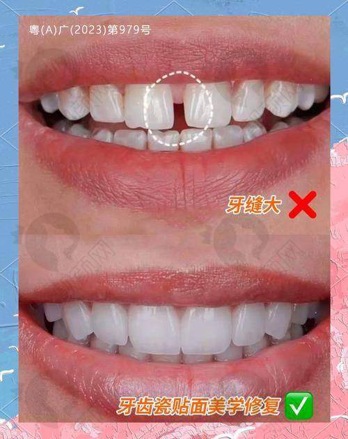 义获嘉西捷美牙冠的高硬度优势体现在哪？