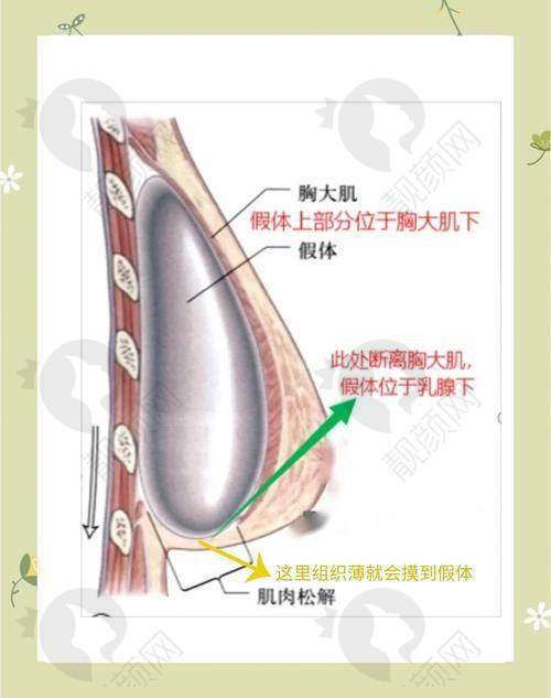 成都谁做假体隆胸手术好？薛瑞医生技术优势明显