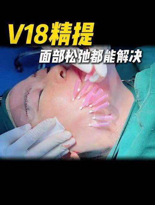 张越越面部年轻化实例