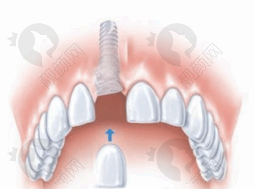 玉溪舒尔口腔医生做根管治疗价格480元起，平价优质服务让市民看牙无负担 