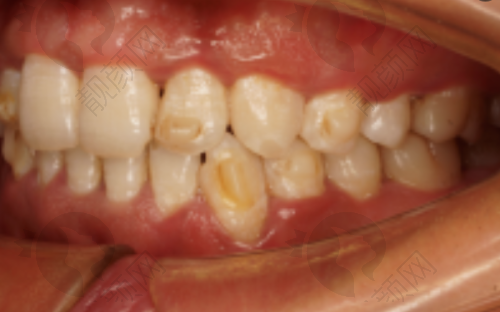 郑州德韩口腔吴豪阳医生做种植牙价格2980元起，亲骨技术缩短恢复周期 