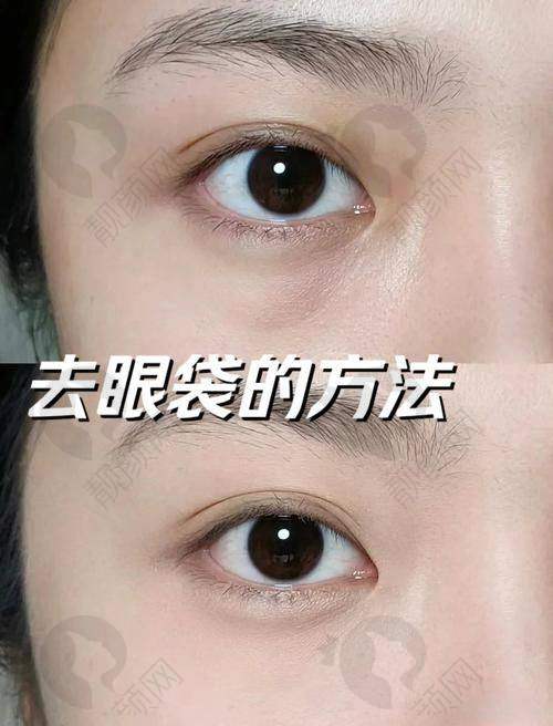 郑州眼袋修复黄军伟医生：强大的技术实力