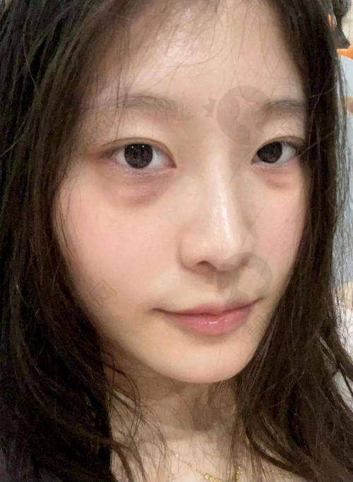 郑州眼袋修复黄军伟医生：良好的口碑评价