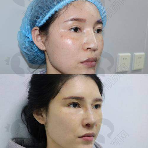 隆鼻3次修复注意事项：做好准备迎接美鼻