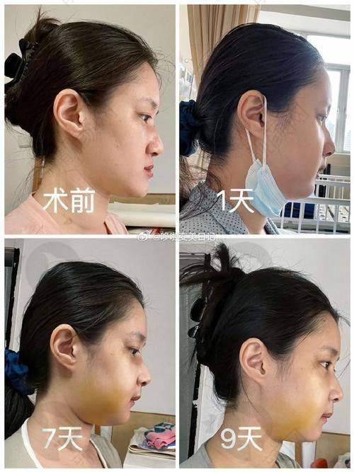 隆鼻3次修复优势：精细方案量身定制