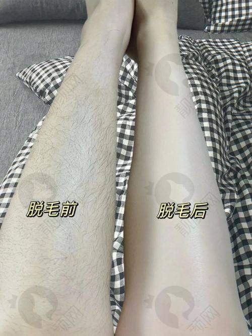 北京美莱医疗美容医院腋下脱毛价格详情解析