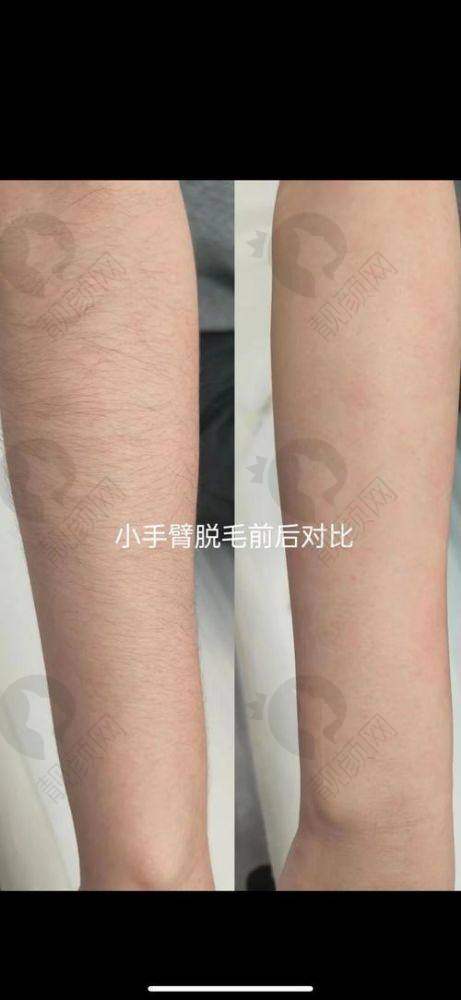 北京美莱医疗美容医院腋下脱毛项目优势