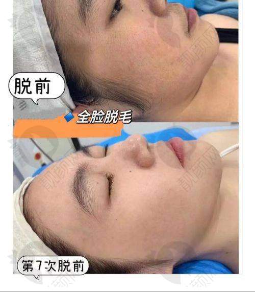 北京美莱医疗美容医院腋下脱毛真实评价