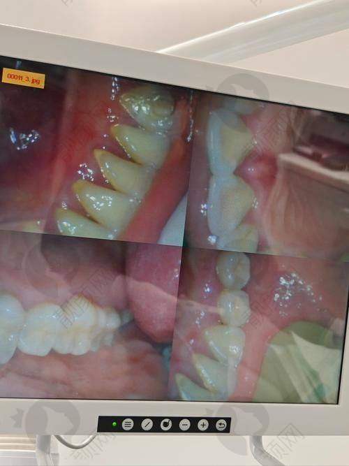 玉溪舒尔口腔洗牙项目的真实评价