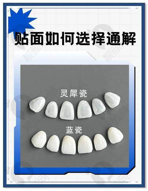 杭州瑞创口腔E - MAX全瓷贴面的优势
