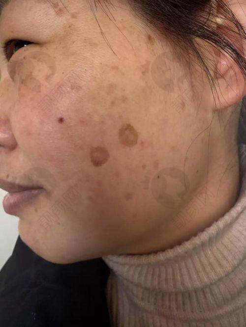 北京艺星医疗美容蜂巢皮秒祛斑真实评价
