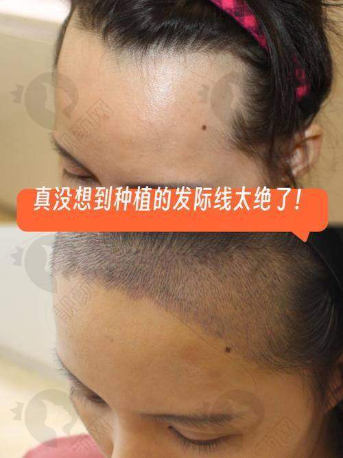 北京美莱医疗美容医院美人尖种植真实评价