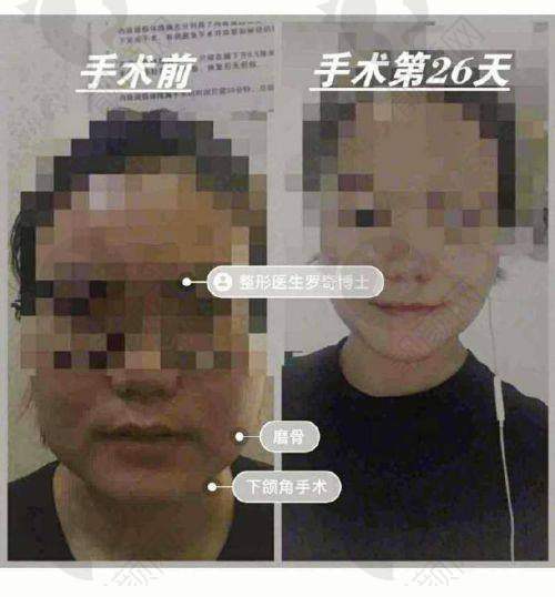 总结：广州磨骨选这两家正规医院准没错
