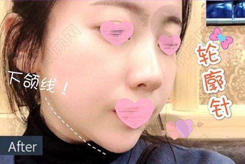 保定悦美整形美容本地口碑超棒,顾客满意度高