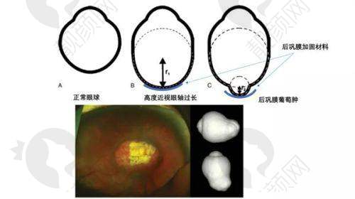 玉林华厦眼科医院 ICL 晶体植入价格26000 元起，享高配低价与贴心服务 