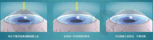 汕尾爱尔眼科医院个性化方案优势