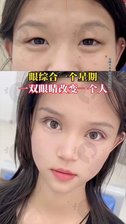 北京美莱医疗美容医院张颖医生6D精雕美眼综合10000元起，创伤小效果自然！ 