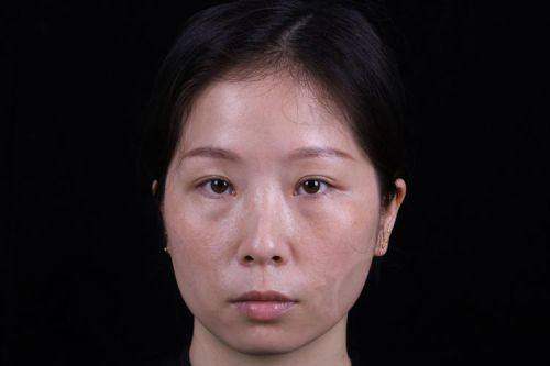 福州眼袋手术去哪里做比较好？精选5家口碑佳正规医院，凭先进技术助您告别眼袋困扰