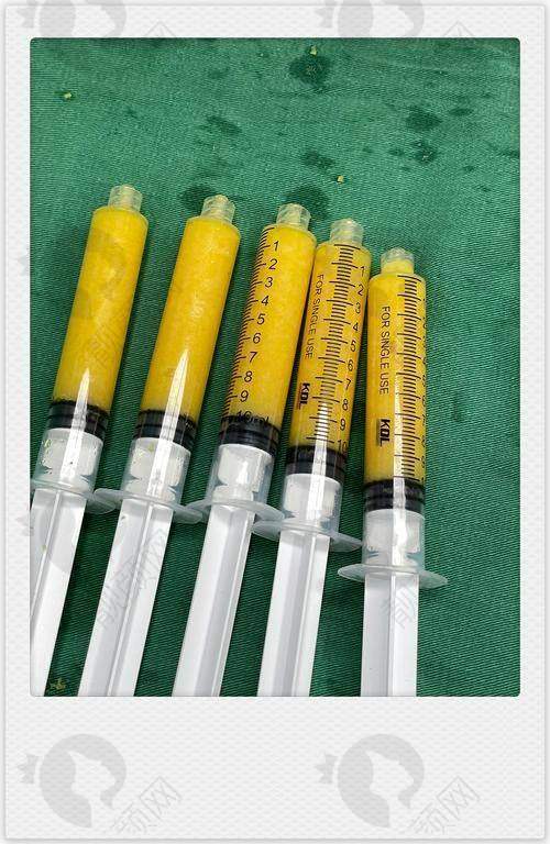选择吸脂医院的注意事项