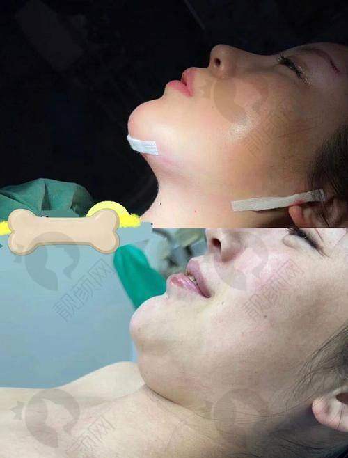哈尔滨下颌角手术价格变化因素分析