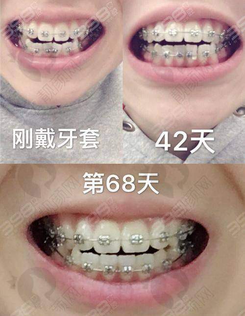 高春菊正畸项目价格表参考