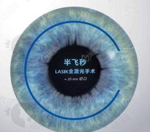 上海新视界眼科半飞秒价格多少？13800元起享个性化矫正与连锁优质服务 