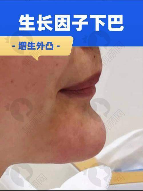 王阔远医生面部减容:众多成功实例见证实力