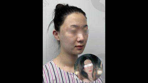 面吸黄金微雕:修复初期的变化