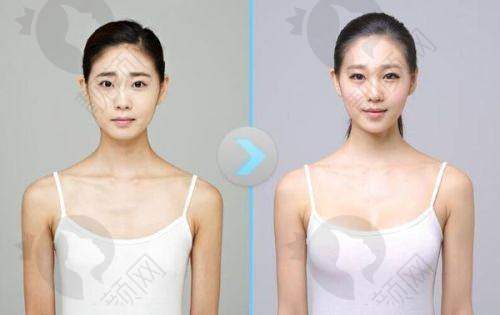 隆胸一月:美丽蜕变的持续开启