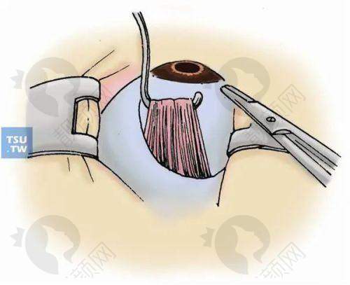 北京熙仁眼科医院青少年近视防控价格多少？2000元起定制方案含检测与干预 