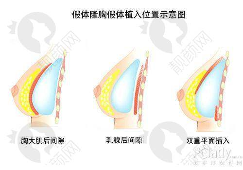 隆胸一月:修复护理的轻松进行