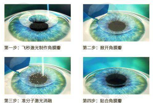我做了重庆千叶眼科医院陈费清医生的半飞秒激光近视矫正，花了1.18w真香！ 