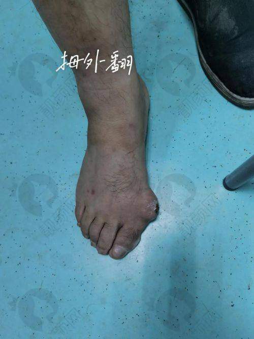 上海虹桥医院做拇外翻:综合实力值得信赖